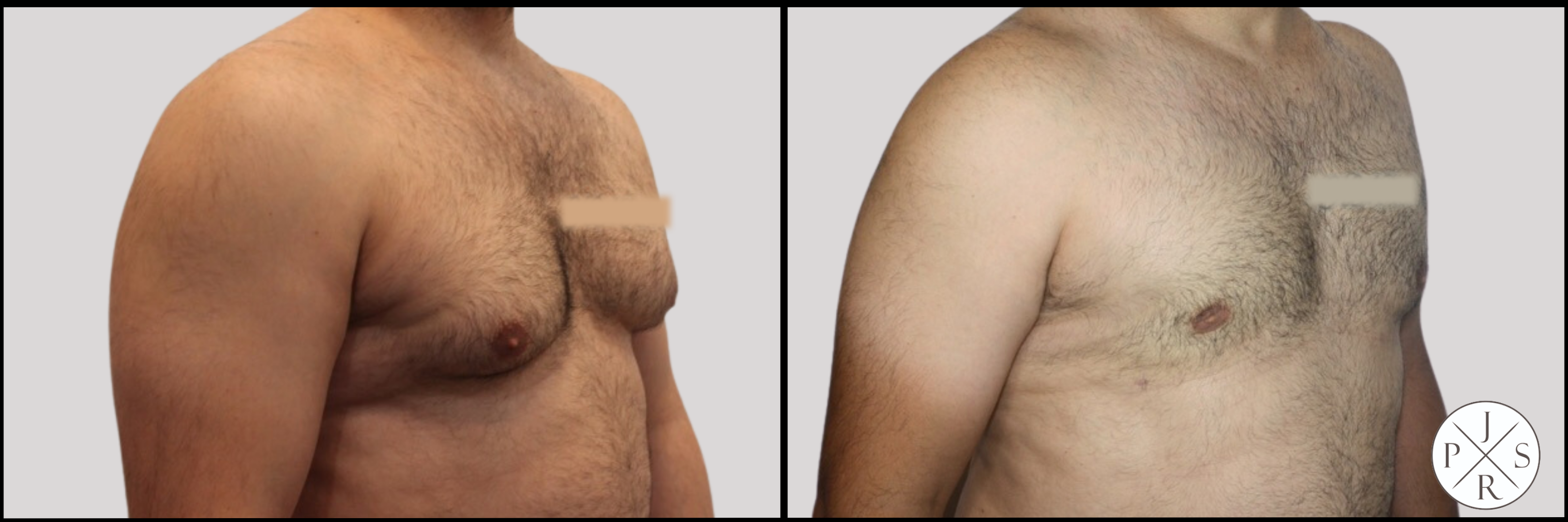 Gynecomastia Before & After Image